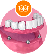 All on four dental implants