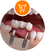 Mini dental Implants