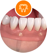 Full Mouth implant