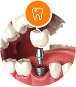 Single Tooth implant