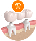 Dental Bridges