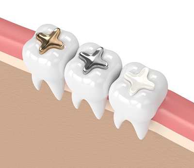 Dental filling White filling Gold filling Silver filling