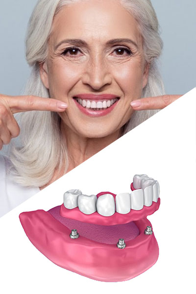 Mid-age women with dental implants