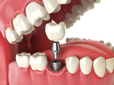 Single tooth Implant