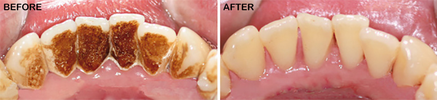 Before & After Air Polish with AirFlow