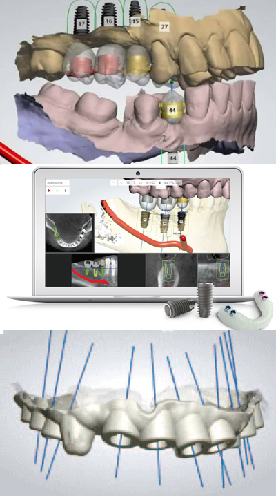 3D non-invasive dental implants