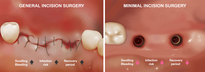 minimal invasive & non-incision dental implants shenas dental