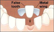 Maryland Dental Bridge