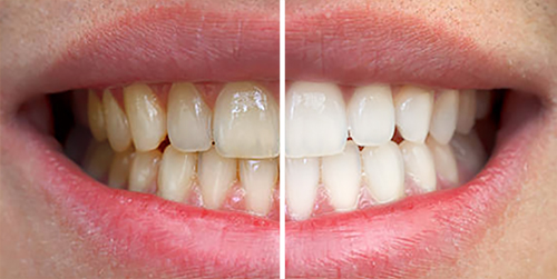 Male Teeth Whitening Before & After Shenas Dental