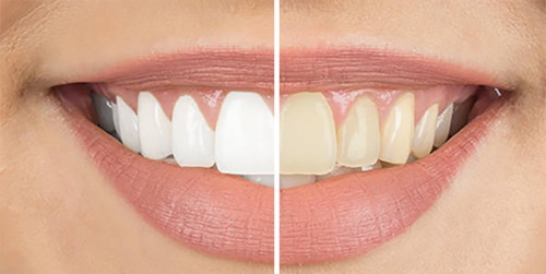 Female Teeth Whitening Before & After Shenas Dental