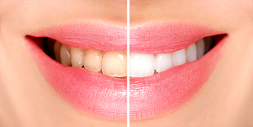 Teeth Whitening Before & After Shenas Dental