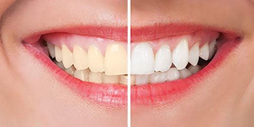 Teeth Whitening Before & After Shenas Dental