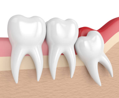 Wisdom tooth extraction