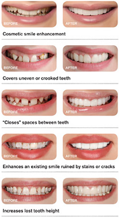 Snap on smile before and after