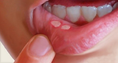 Aphthous ulcers / Canker Sores