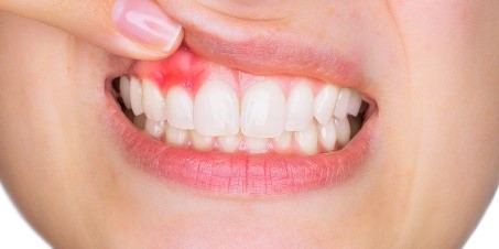 Periodontal Disease