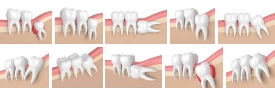 Wisdom tooth types